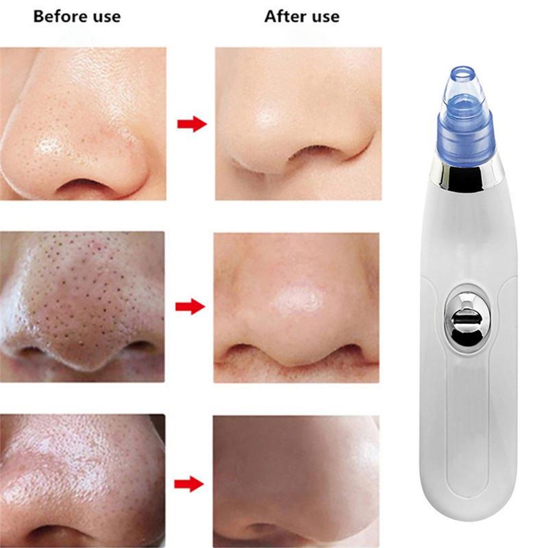 VACUUM PORE CLEANER